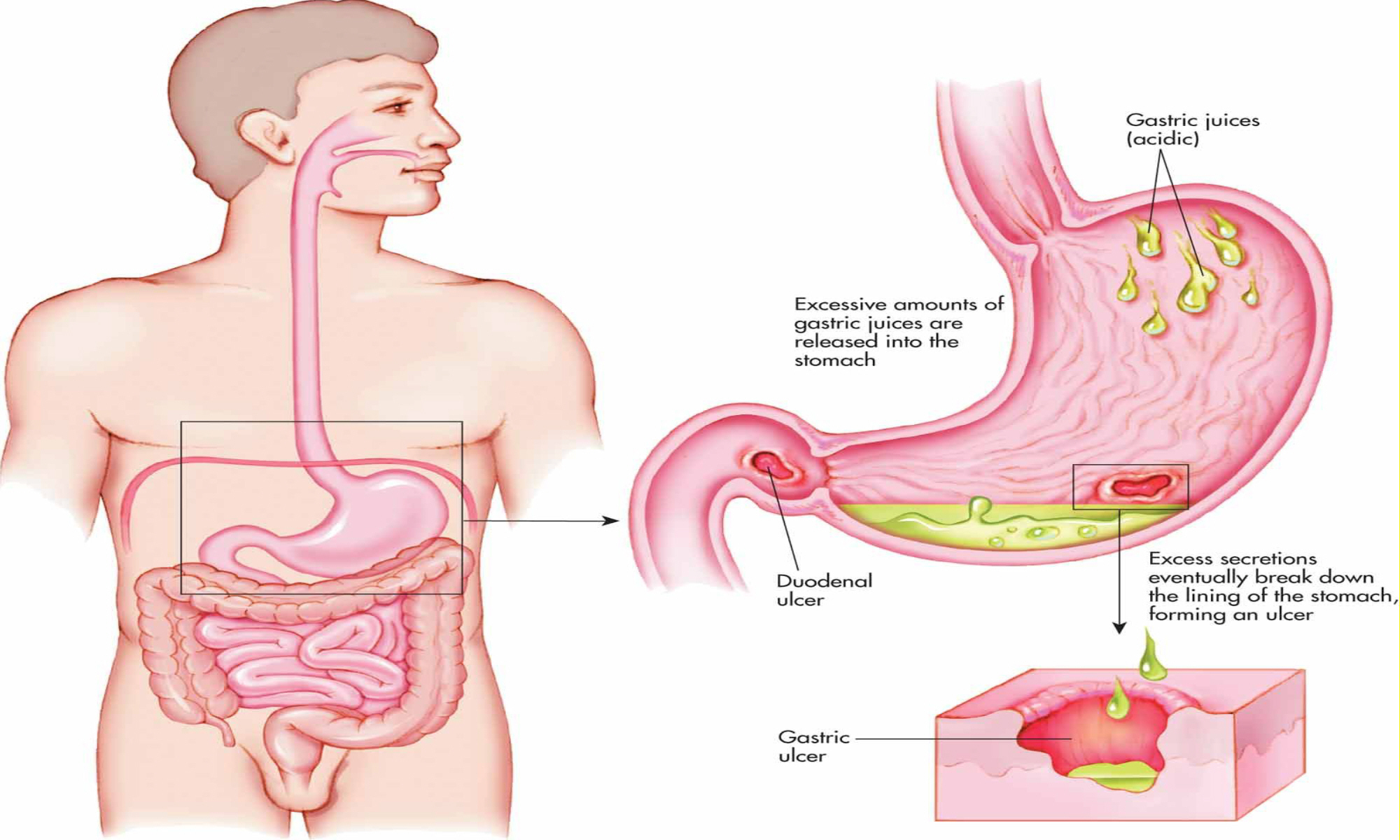 chronic diseases