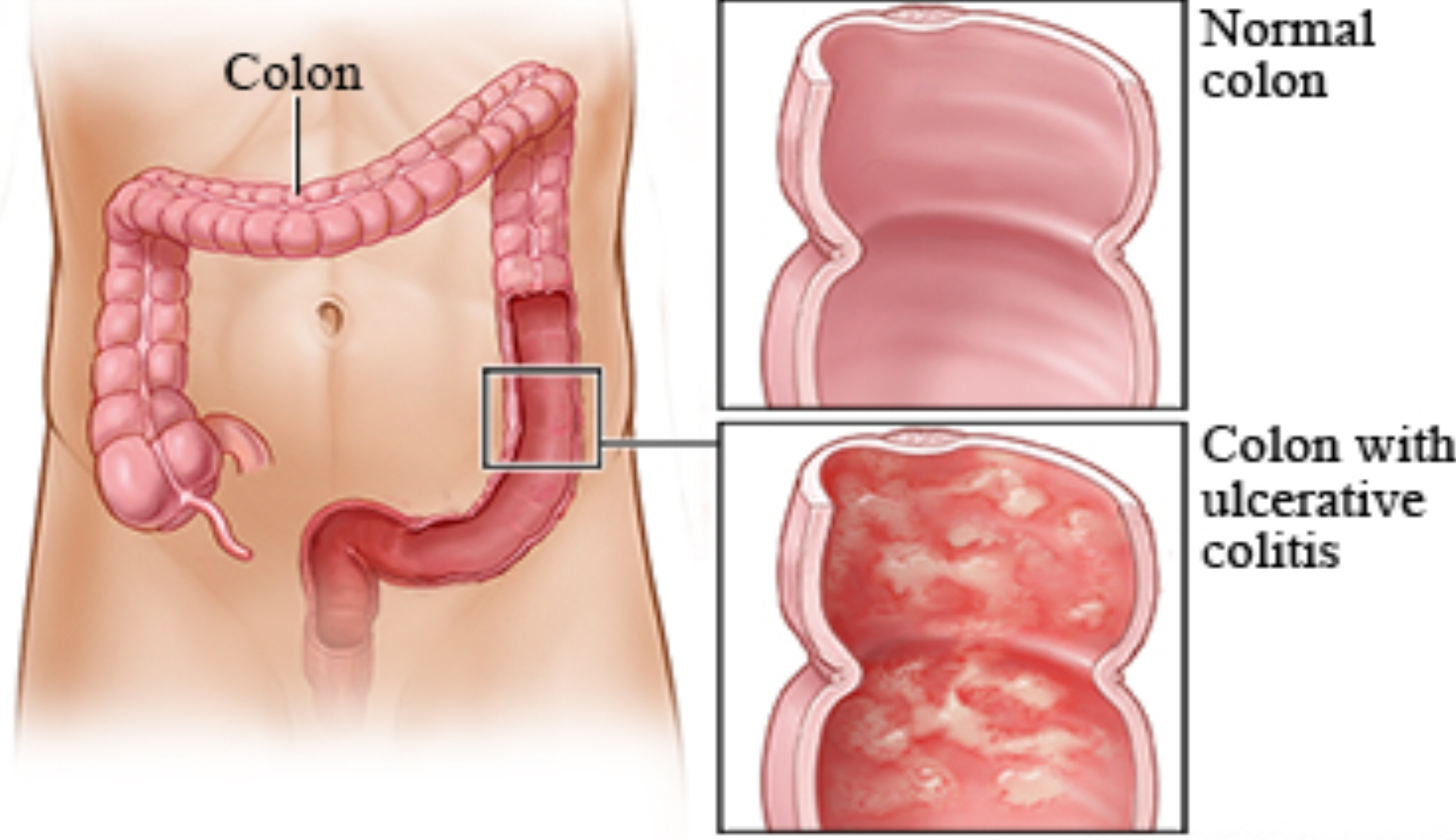 chronic diseases