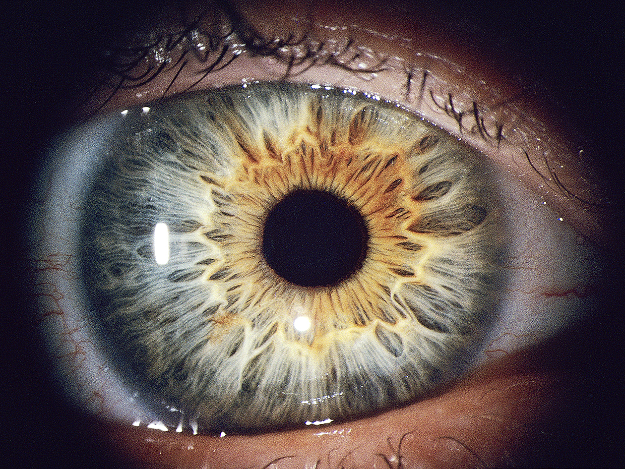 abnormal iris